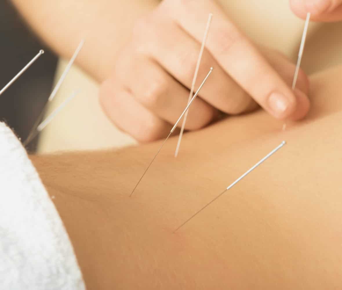 本格的な鍼治療