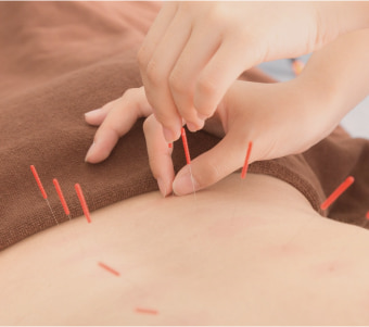 鍼治療