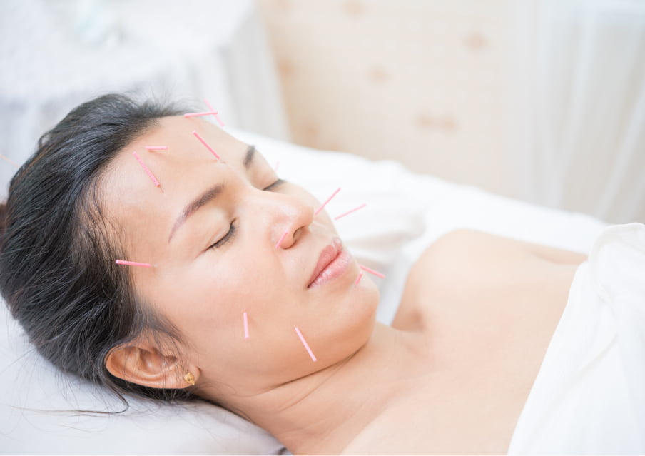 美容鍼